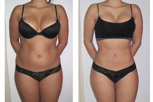 fat reduction